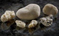 人为什么会长结石