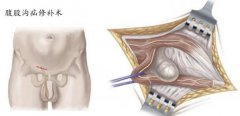 疝气的危害都有哪些