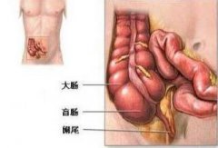阑尾炎如何治疗