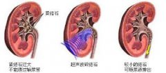 肾结石疼痛怎么办