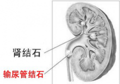 肾结石如何治疗