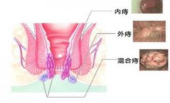TST痔疮手术需要多少钱